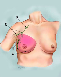 Simple Mastectomy