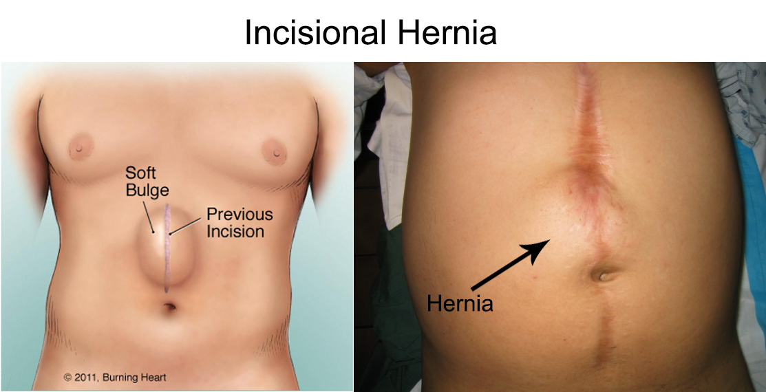 What should you expect after hernia surgery?