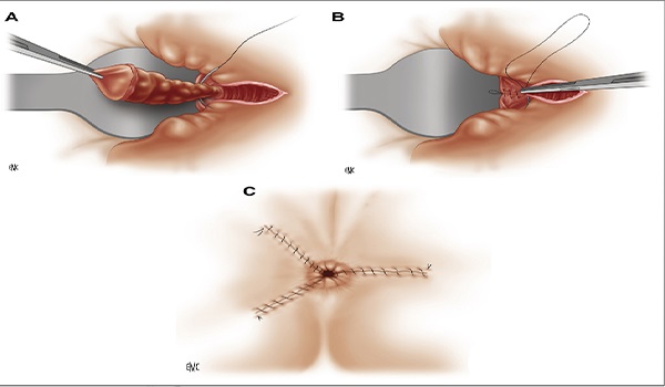 Hemorrhoid Surgery