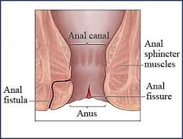 anal fissure and fistula