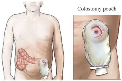 colostomy illustration