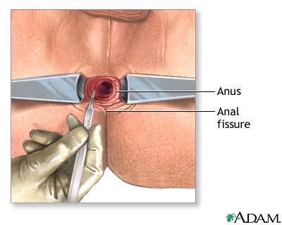 anal fissure treatment
