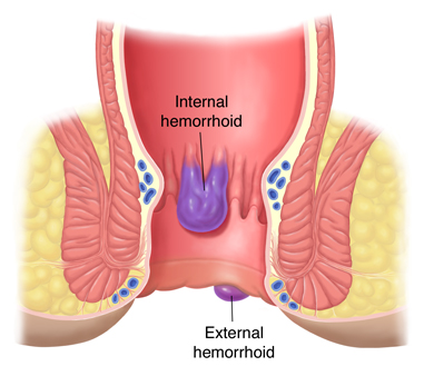 What are Hemorrhoids